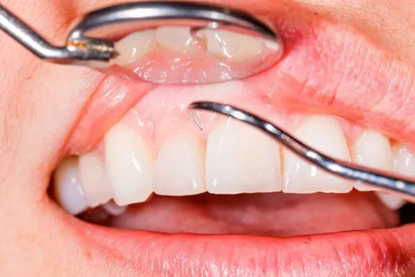 Здоровые зубы и дёсны