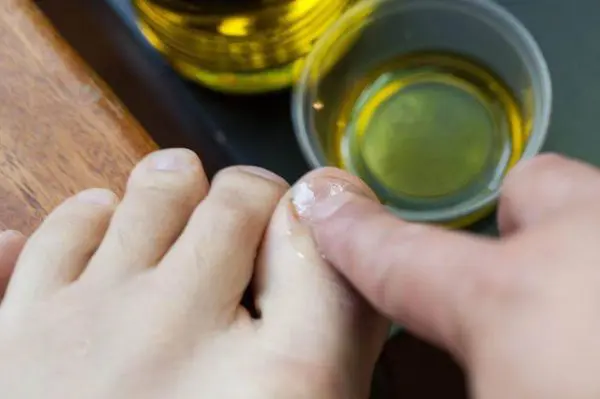 Лечение ногтей маслом чайного дерева