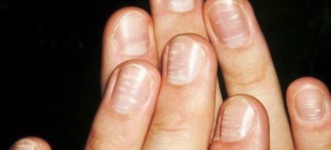 белые полоски на ногтях рук